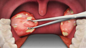 Surgical tonsillectomy