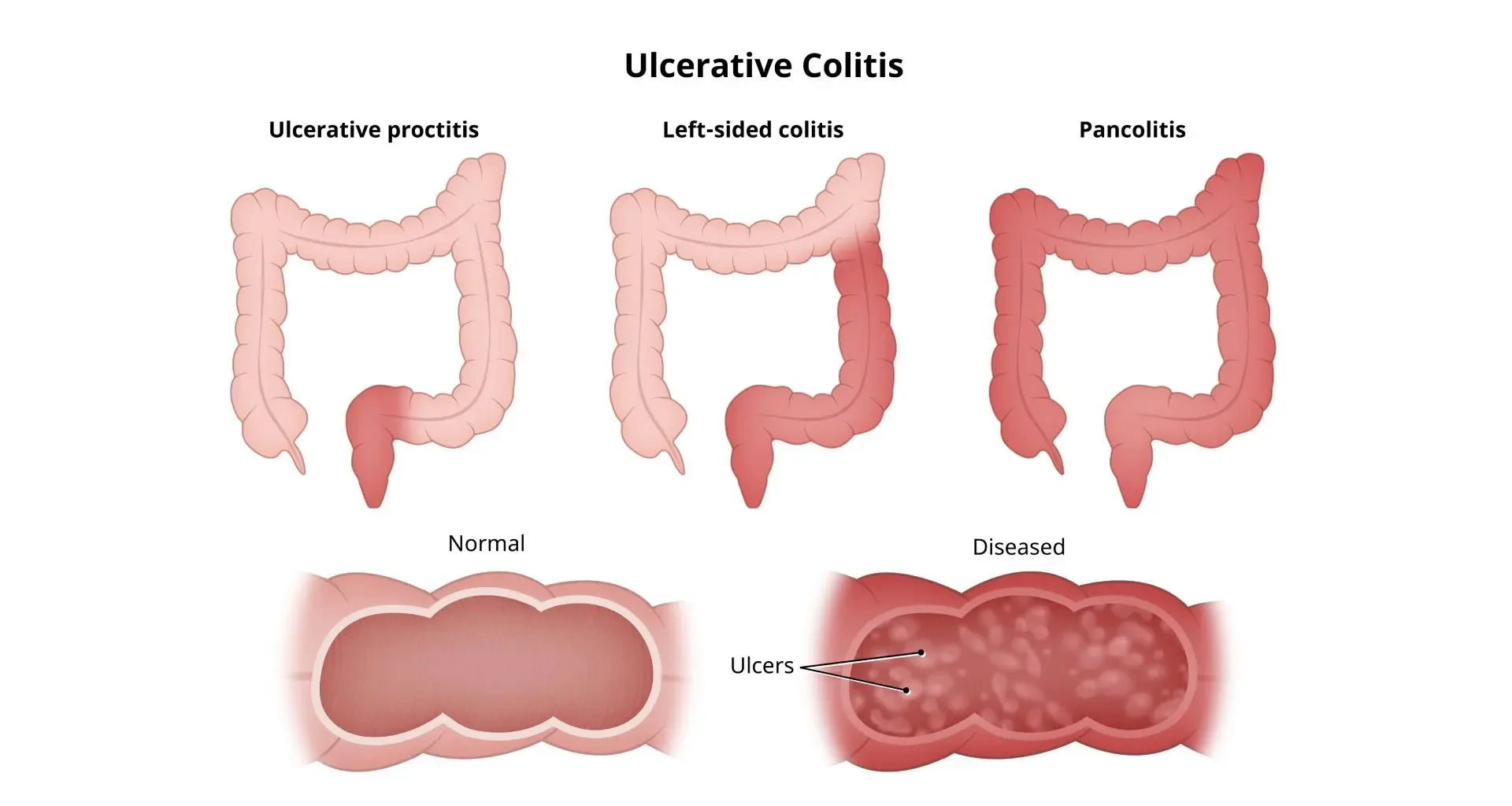 التهاب القولون التقرحي - Ulcerative Colitis