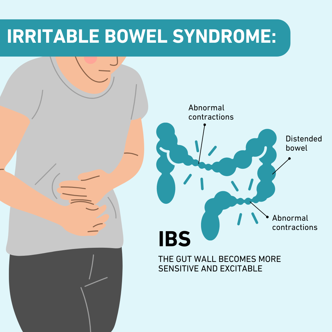 متلازمة القولون العصبي - Irritable Bowel Syndrome (IBS)