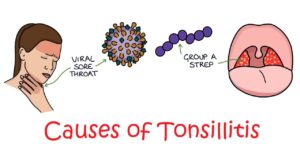 أسباب التهاب اللوزتين