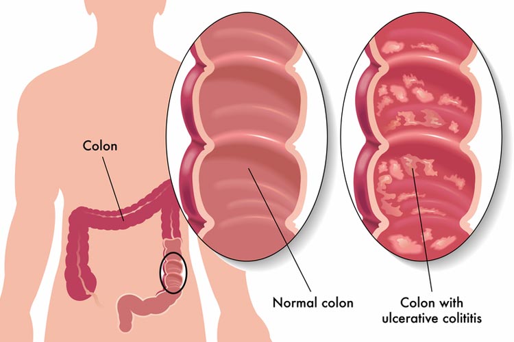 التهاب القولون التقرحي - Ulcerative Colitis