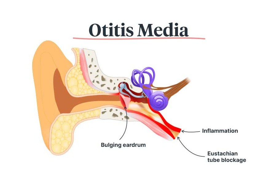 التهاب الأذن الوسطى