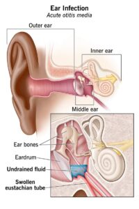 التهاب الأذن الوسطى