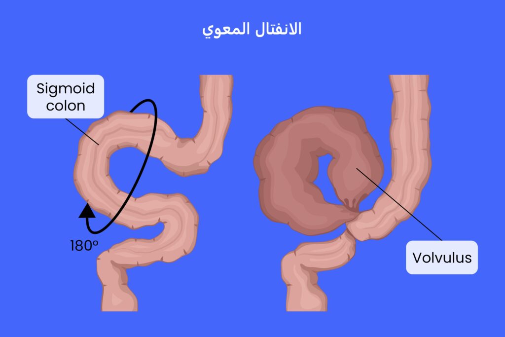 الانفتال المعوي