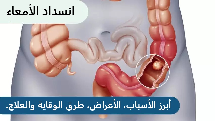 انسداد الأمعاء