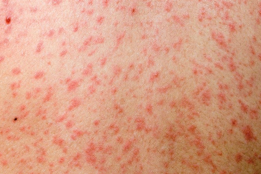 Measles