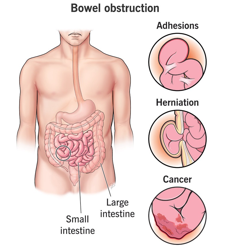 انسداد الأمعاء