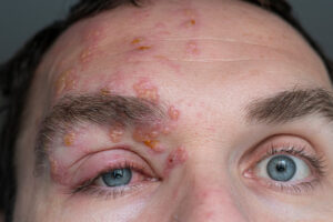 Herpes Zoster Ophthalmicus