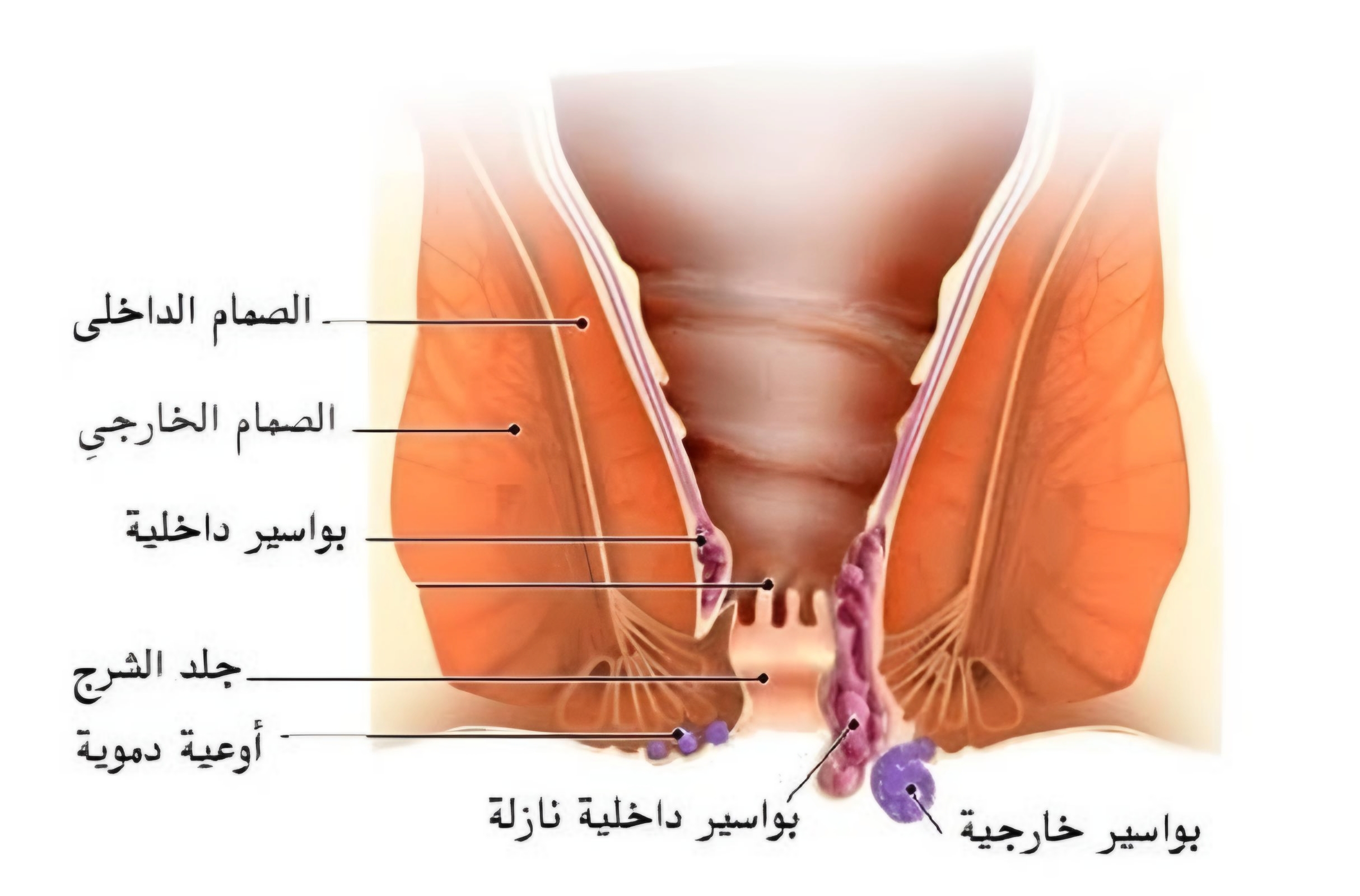 انواع البواسير 