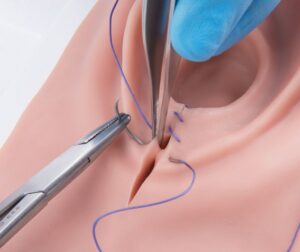 علامات تفكك خيوط الولادة الطبيعية
