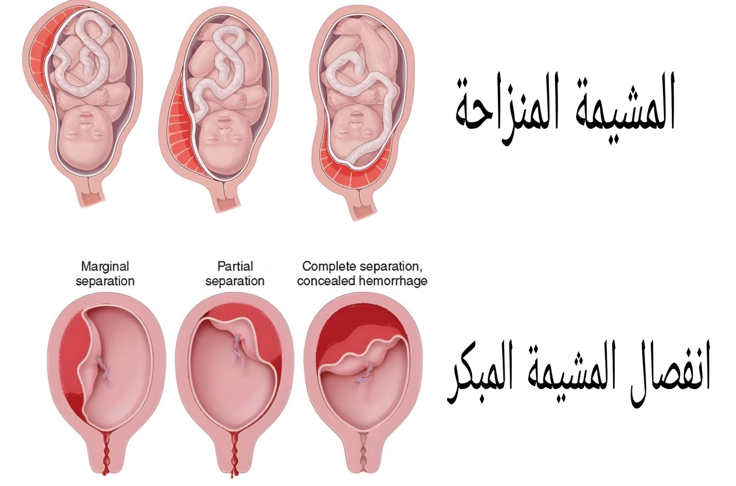 الفرق بين انفصال المشيمة والمشيمة المنزاحة