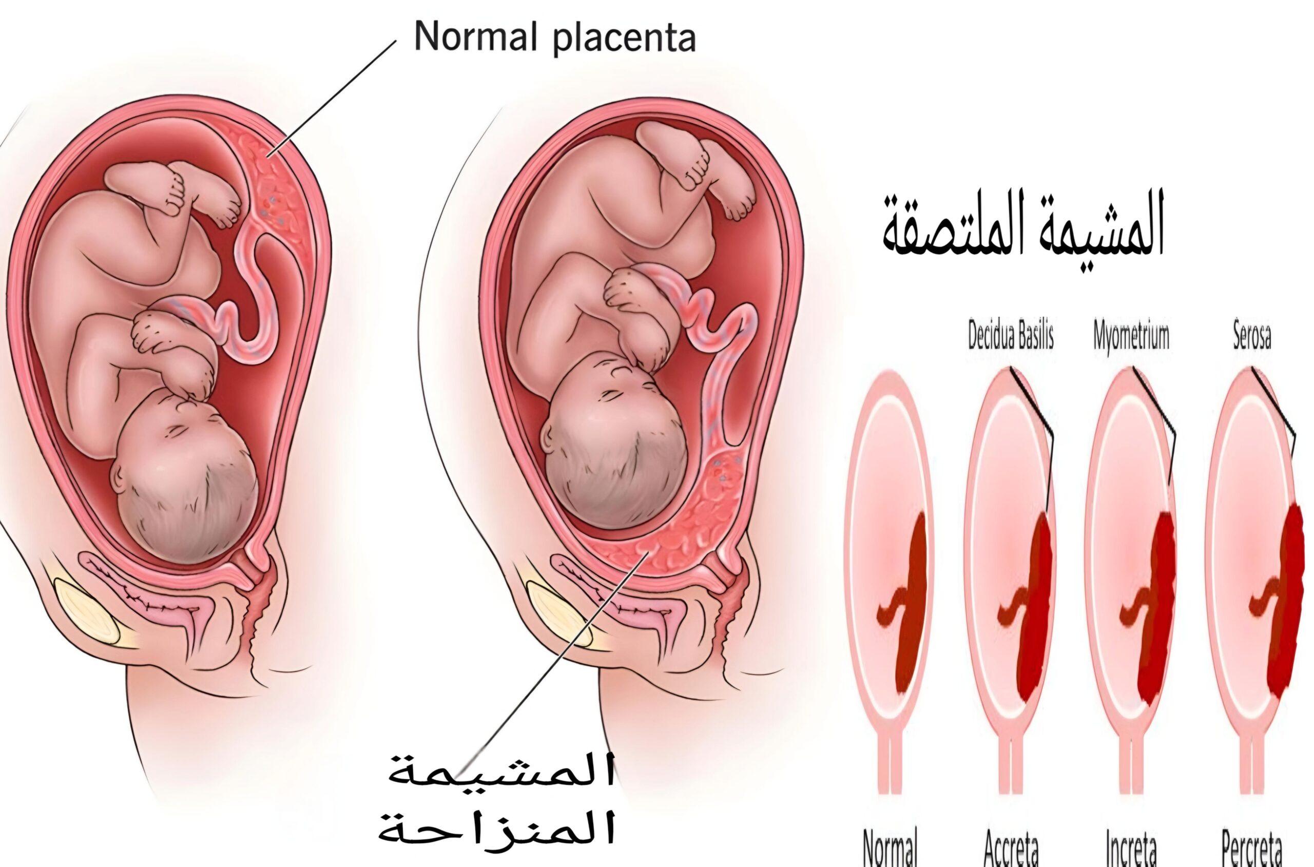 المشيمة المنزاحة والمشيمة الملتصقة 