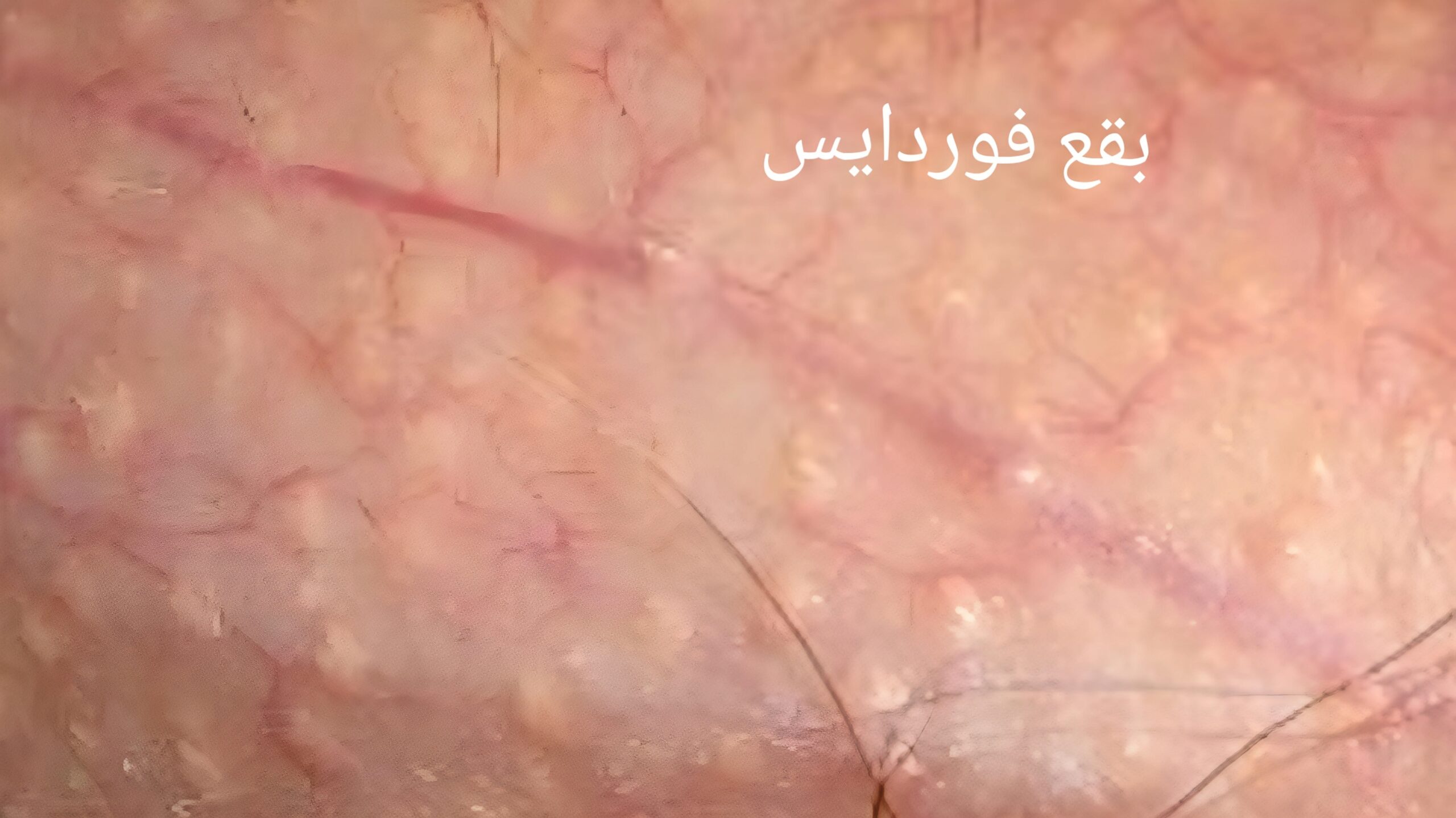 بقع فوردايس 