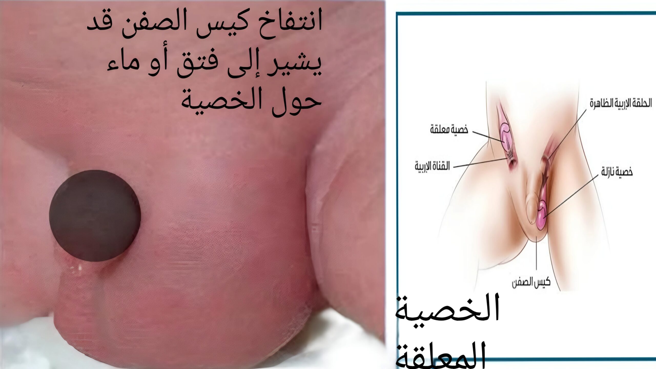علامات في كيس الصفن تستدعي الانتباه عند الرضع 