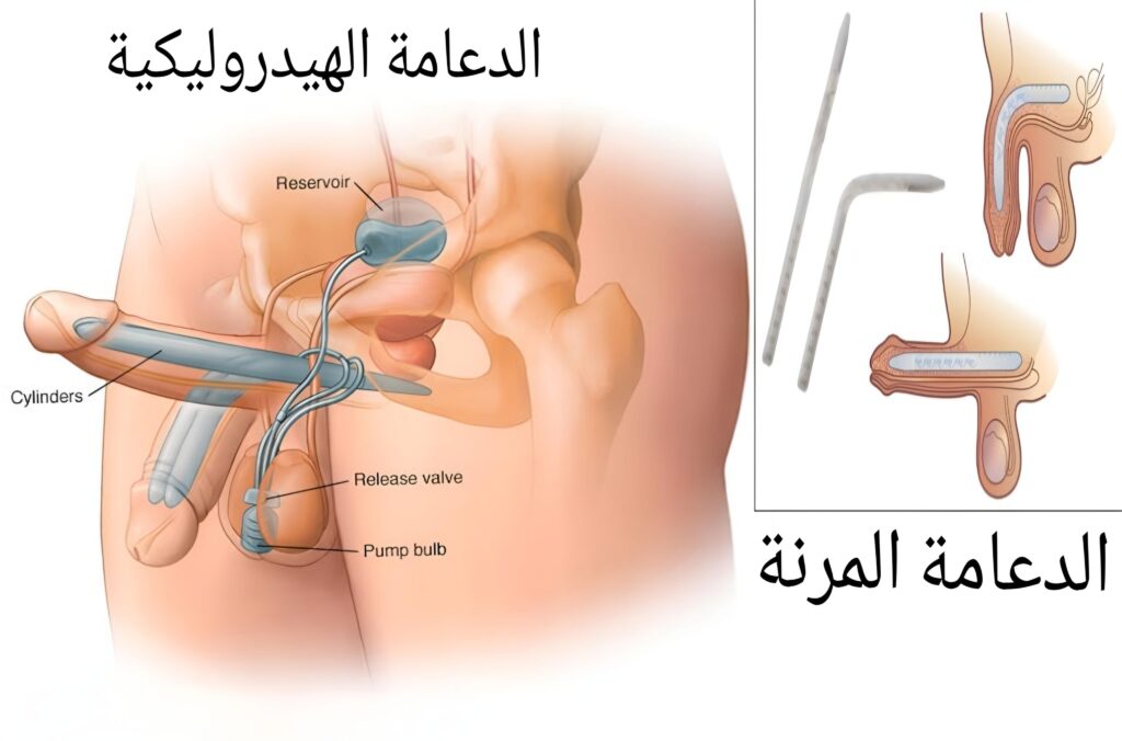 الدعامة المرنة والدعامة الهيدروليكية للعضو الذكري 