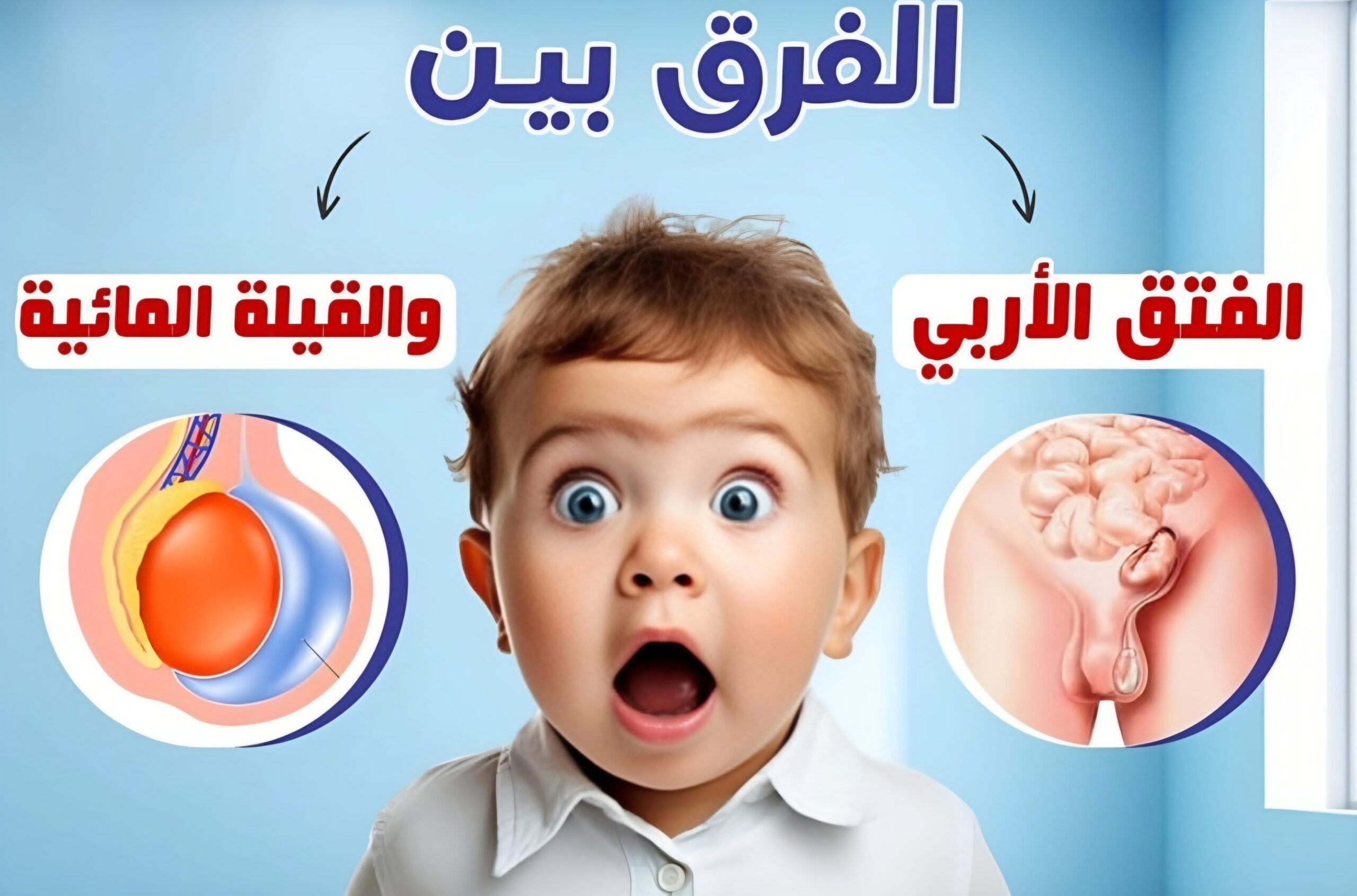 الفرق بين القيلة المائية والفتق الإربي 