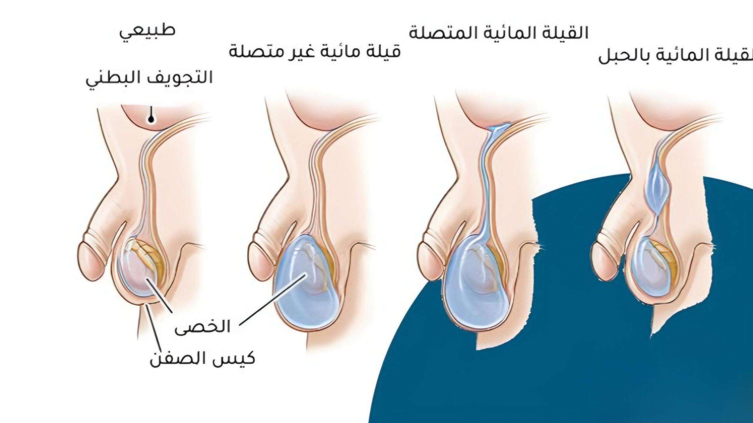أنواع القيلة المائية 