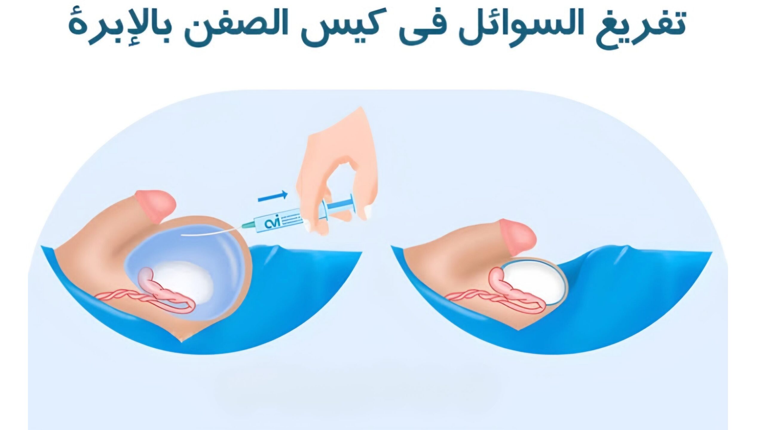 تفريغ السوائل في كيس الصفن بالإبرة 