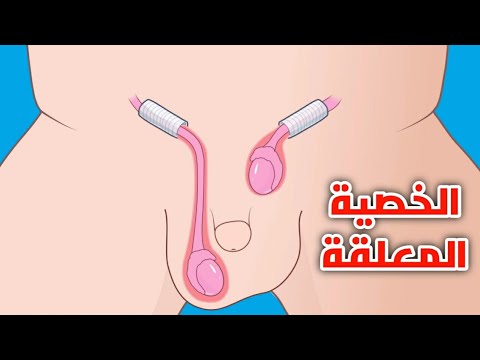 الوقت المناسب لعملية الخصية المعلقة للكبار
