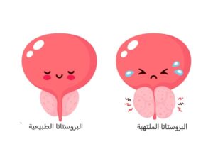 التهاب البروستاتا المزمن