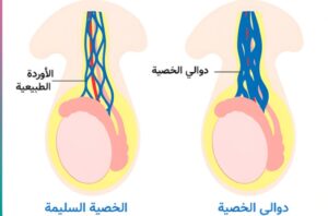 شكل الخصية المصابة بالدوالي