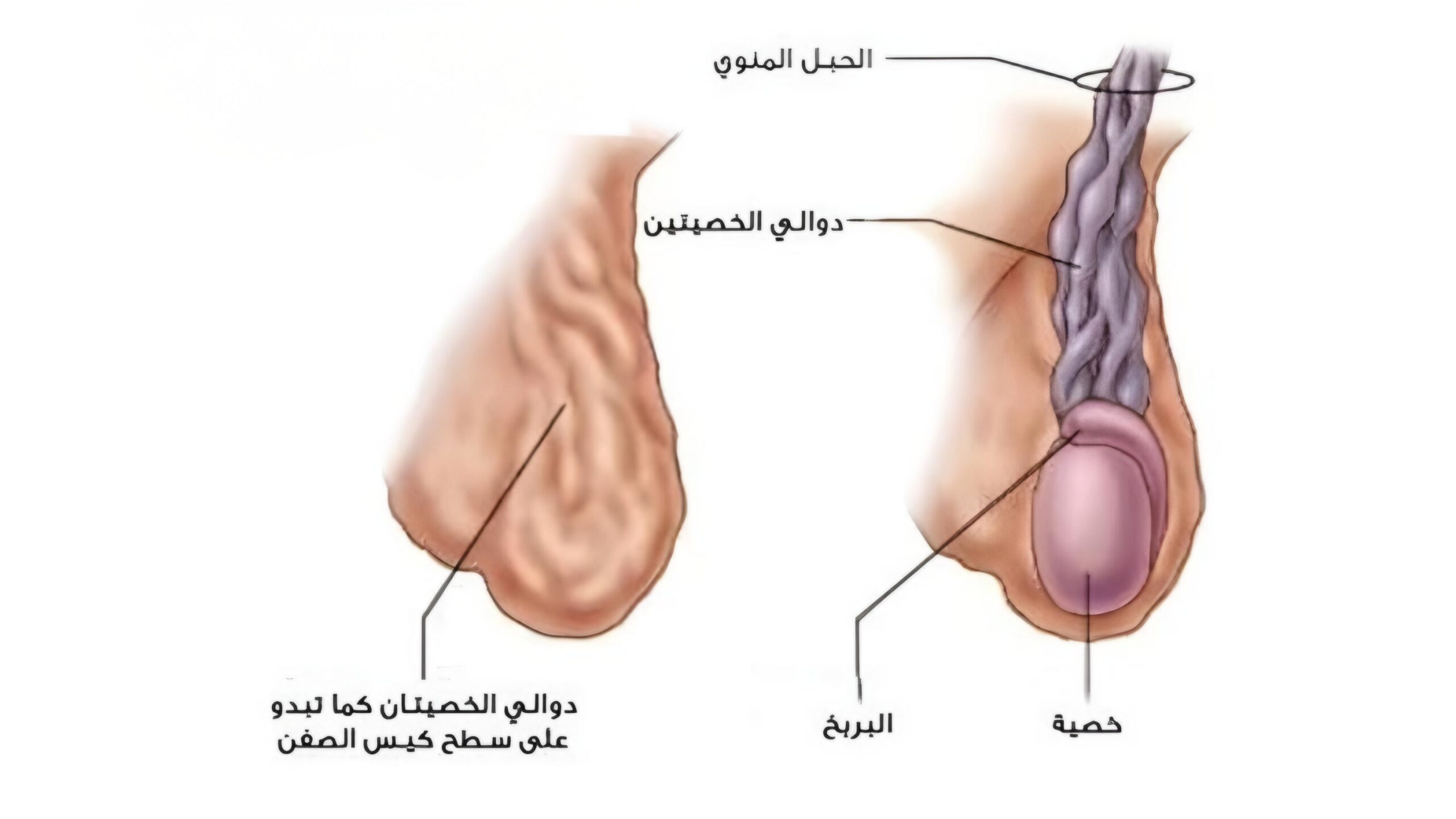 دوالي الخصيتين 