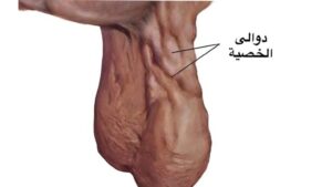 شكل الخصية المصابة بالدوالي