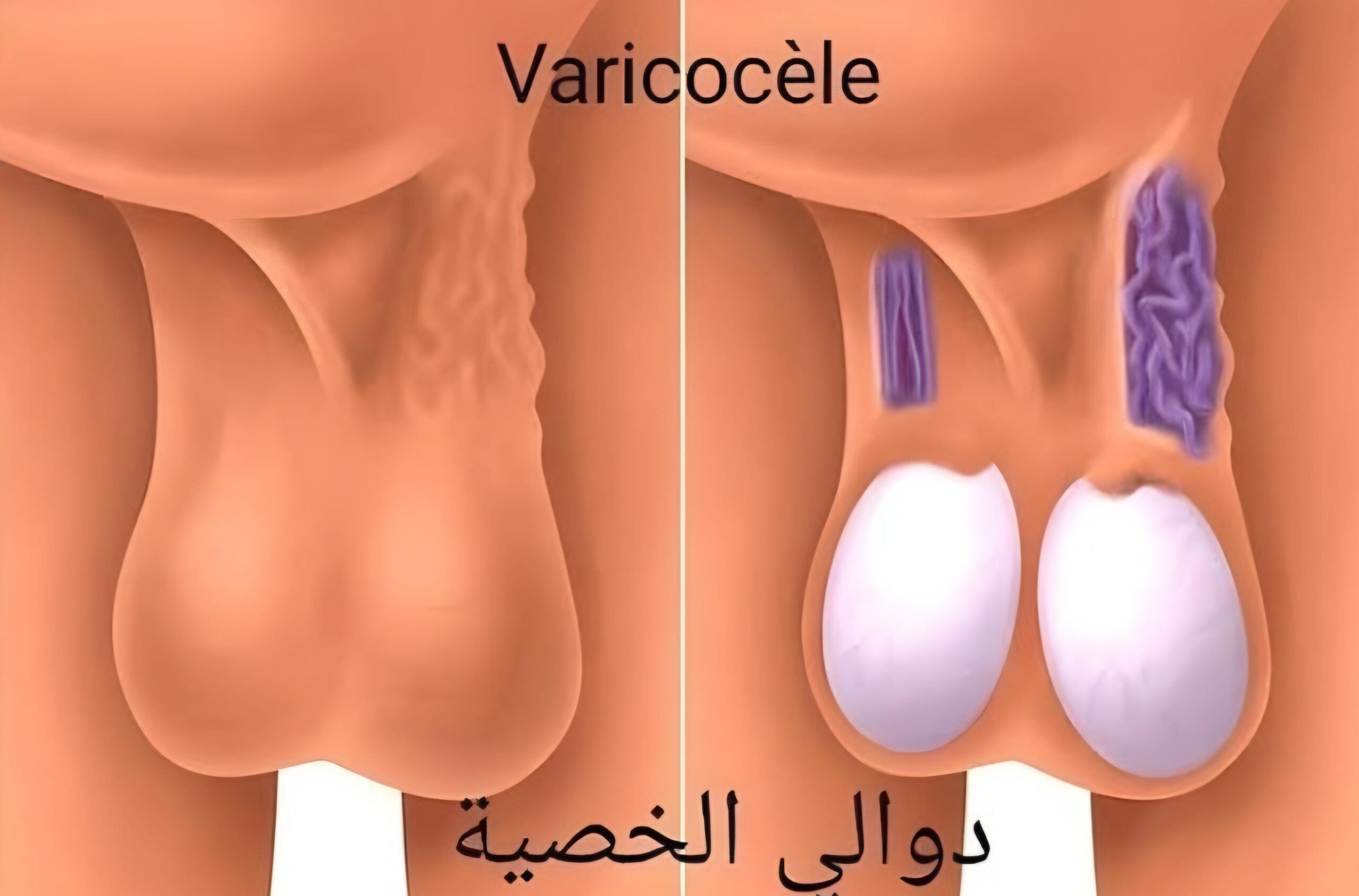 طرق علاج دوالي الخصية 