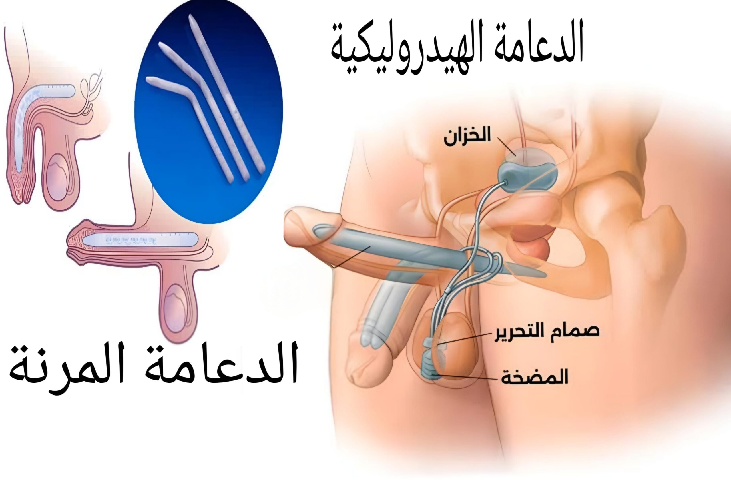أنواع دعامات العضو الذكري 