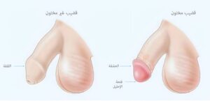 الختان
