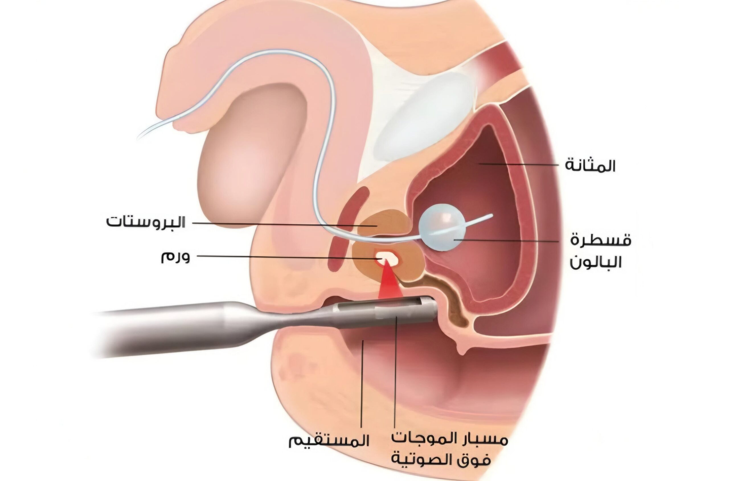أشعة موجات فوق صوتية للبروستاتا