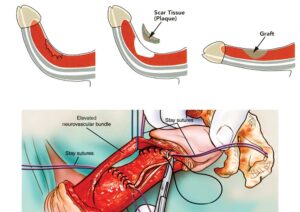 Peyronie's Disease Surgery