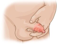 التهاب الحشفة Balanitis