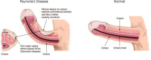 Peyronie's Disease