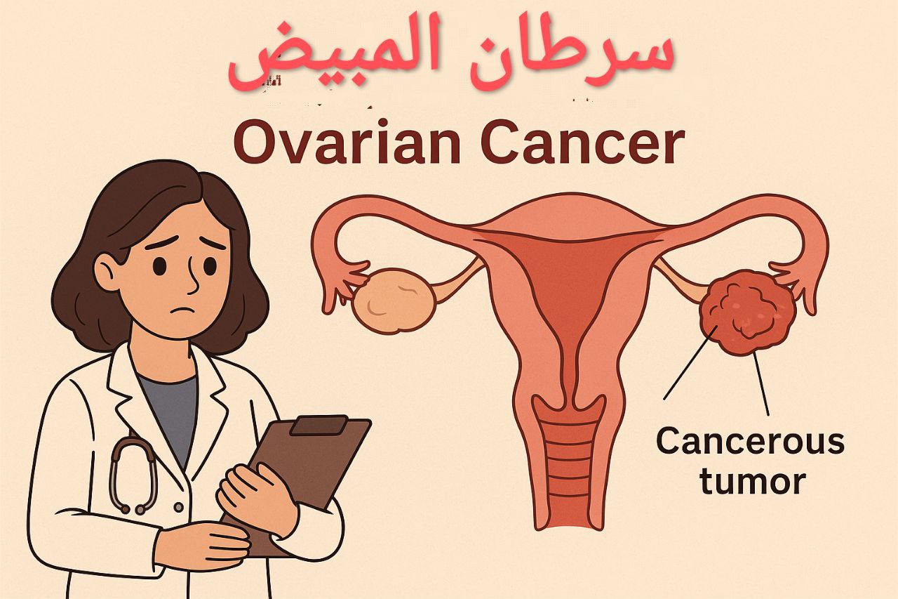 سرطان المبيض