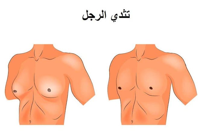 تثدي الرجال