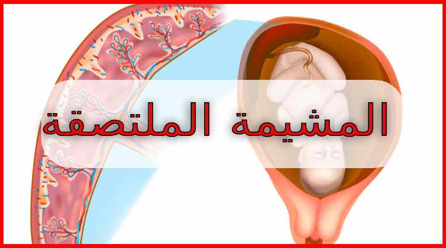 المشيمة الملتصقة