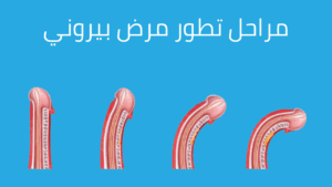 مراحل مرض بيروني