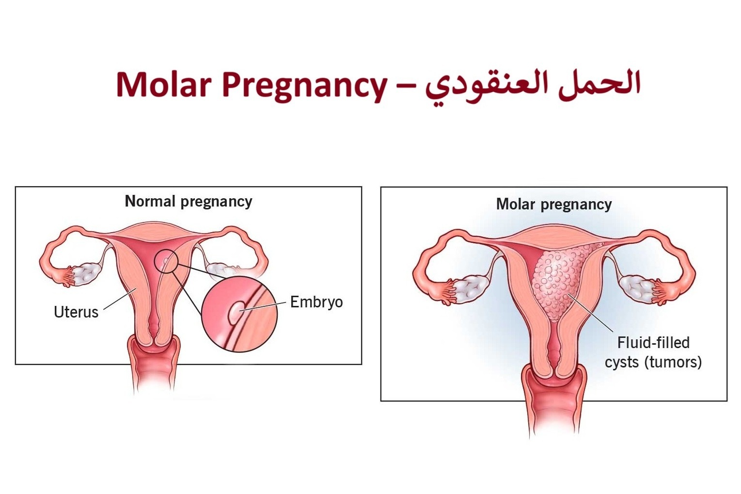 الحمل العنقودي