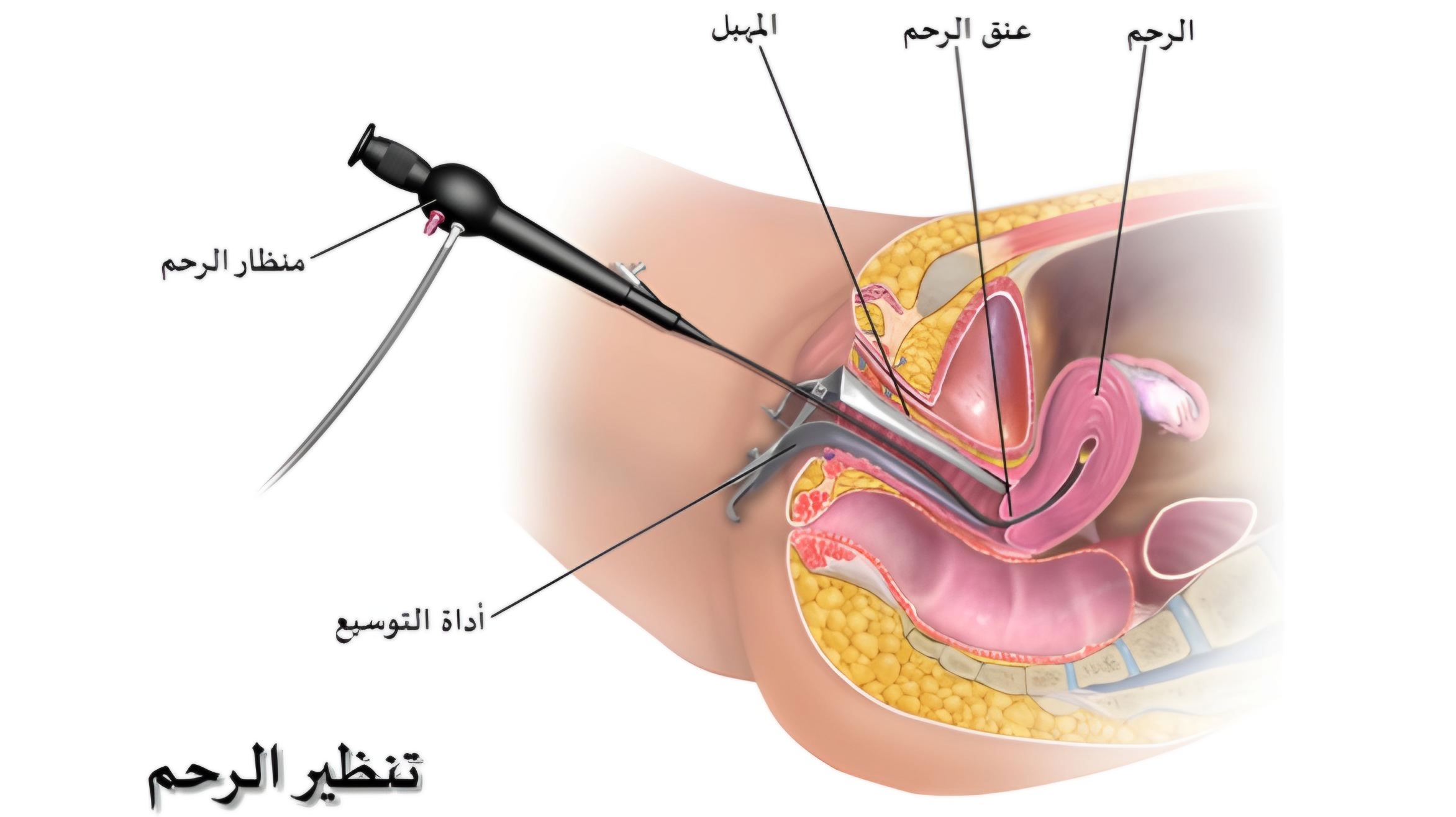 تنظير الرحم 