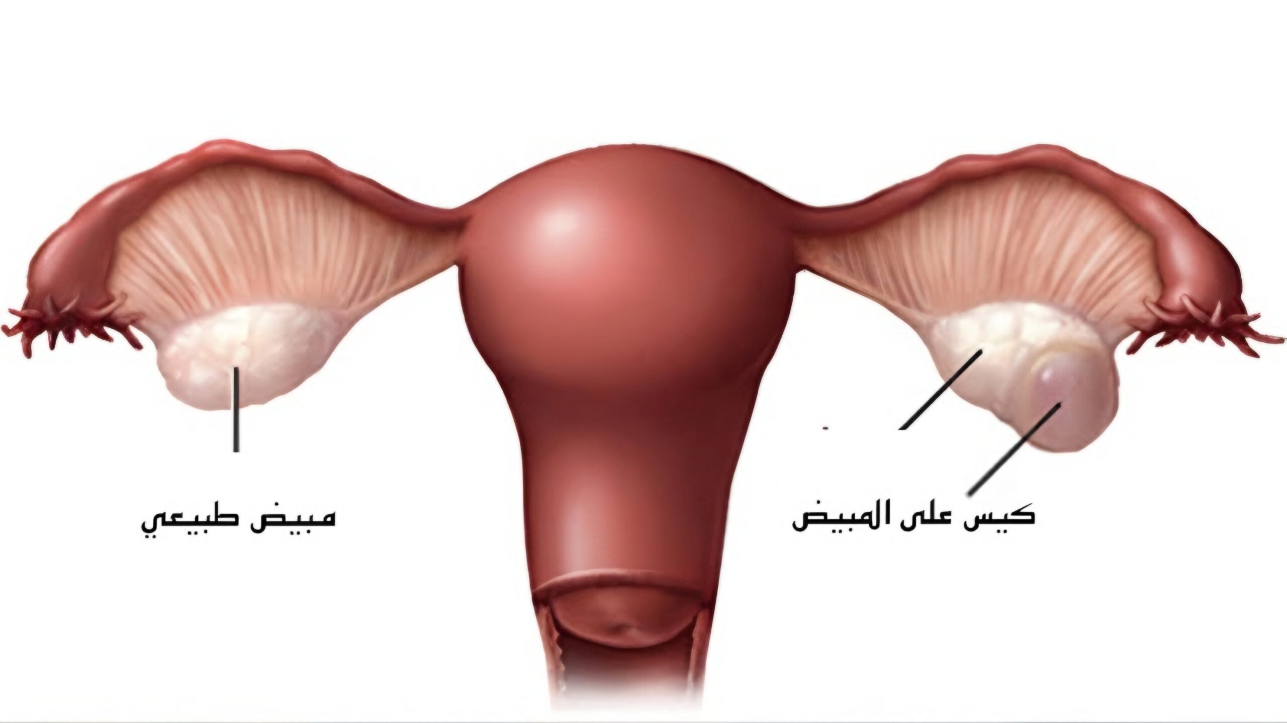 المضاعفات المحتملة لتكيس المبايض