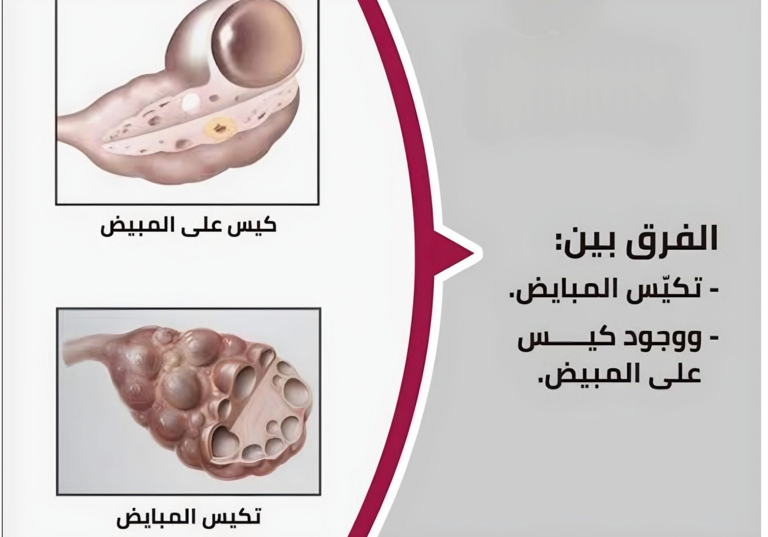 الفرق بين تكيس المبايض واكياس المبيض 