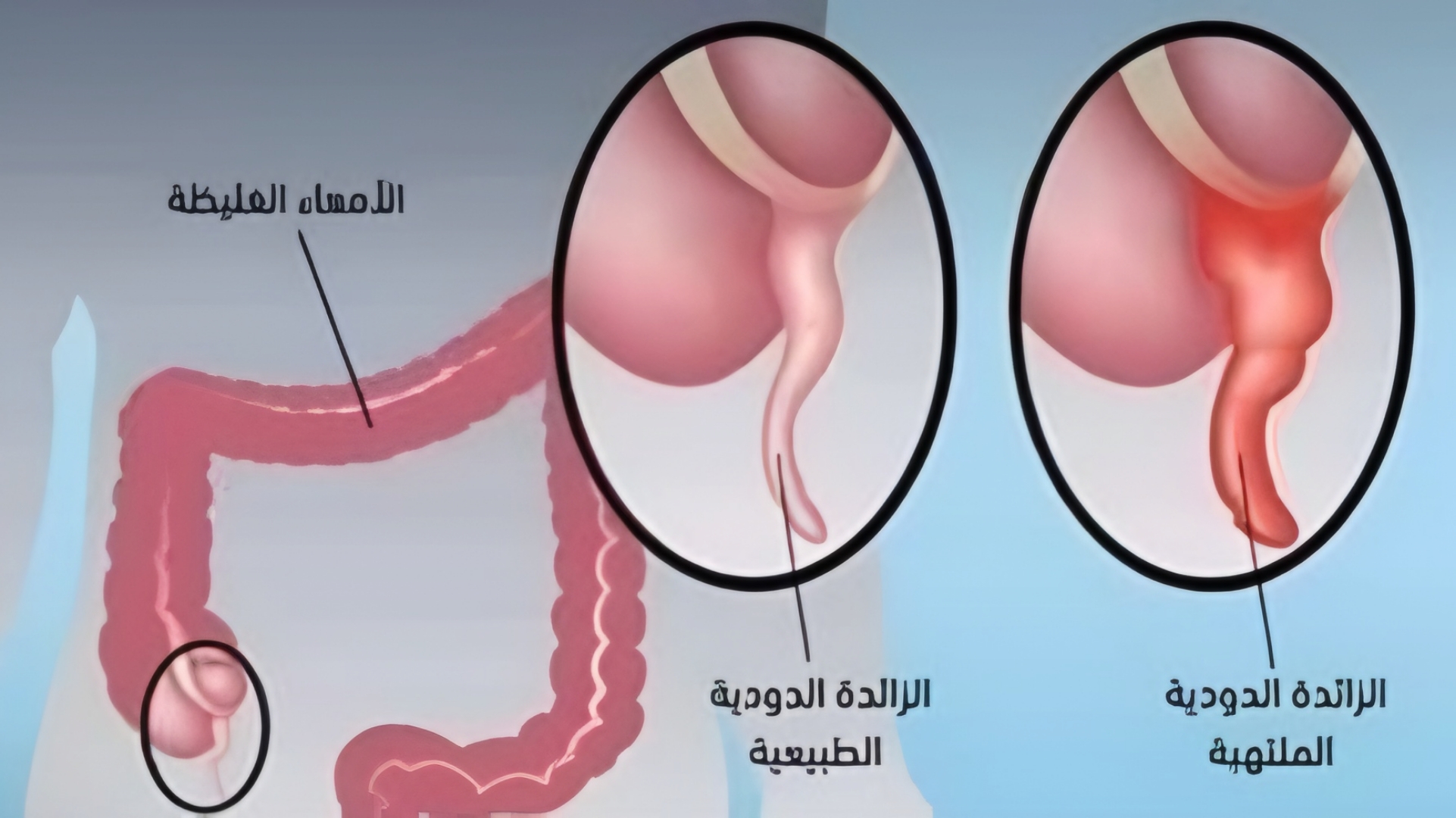 أسباب التهاب الزائدة الدودية عند النساء 