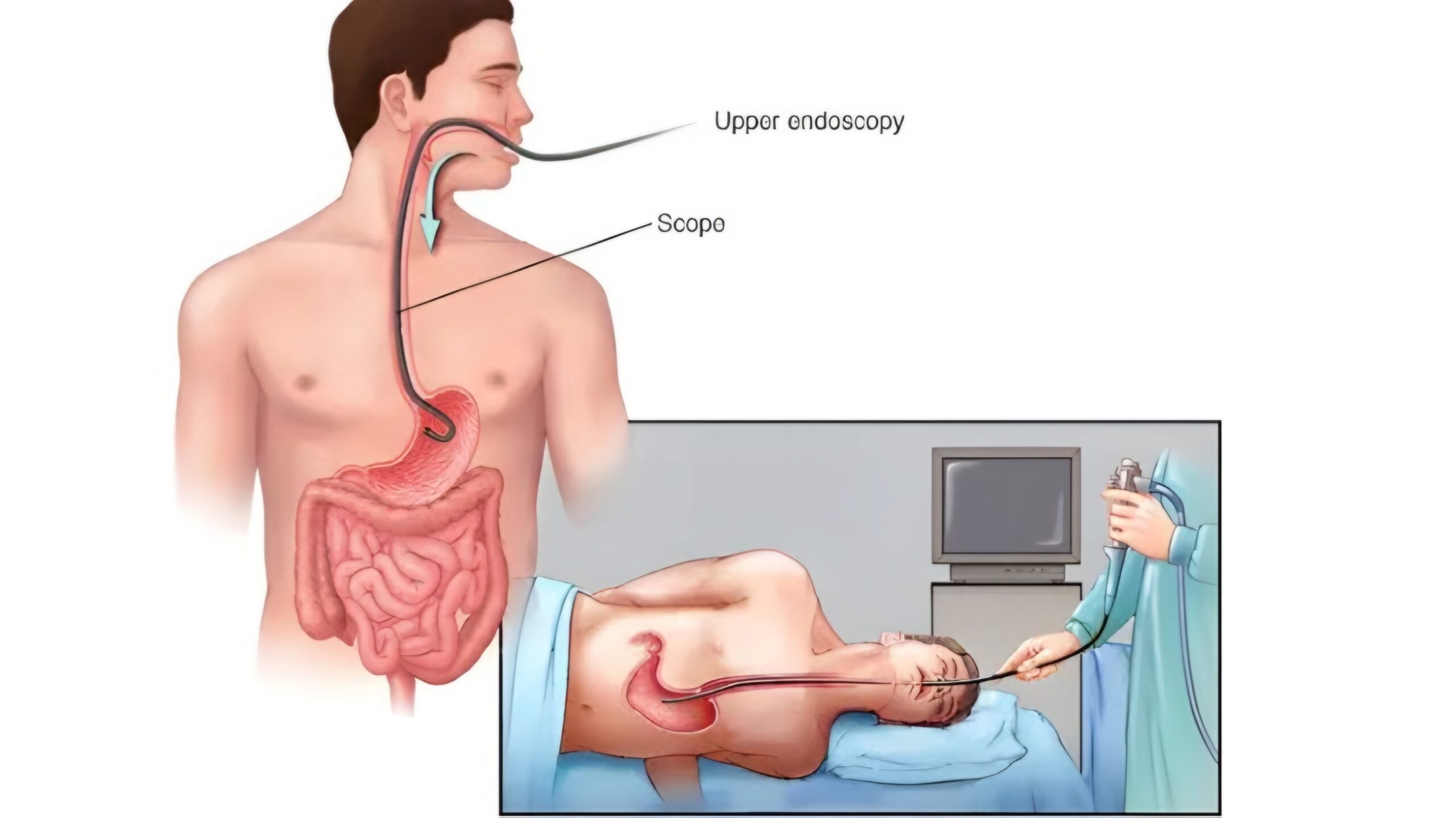 منظار علوي (Endoscopy)، لفحص المعدة والمريء.