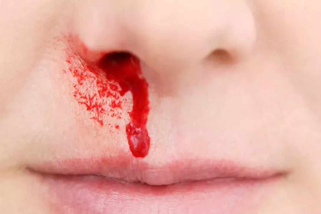 سبب نزول الدم من الأنف من فتحة واحدة
