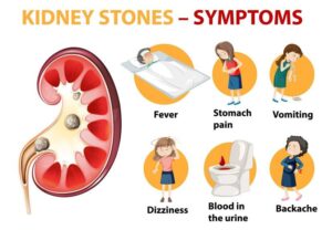 حصى الكلى Kidney Stones (Nephrolithiasis)
