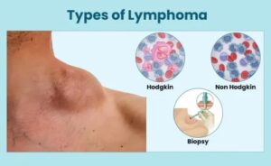 Types of Lymphoma