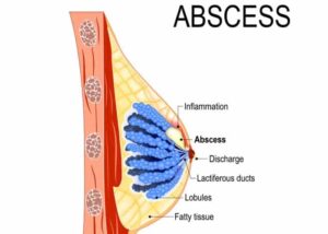 Breast Abscess