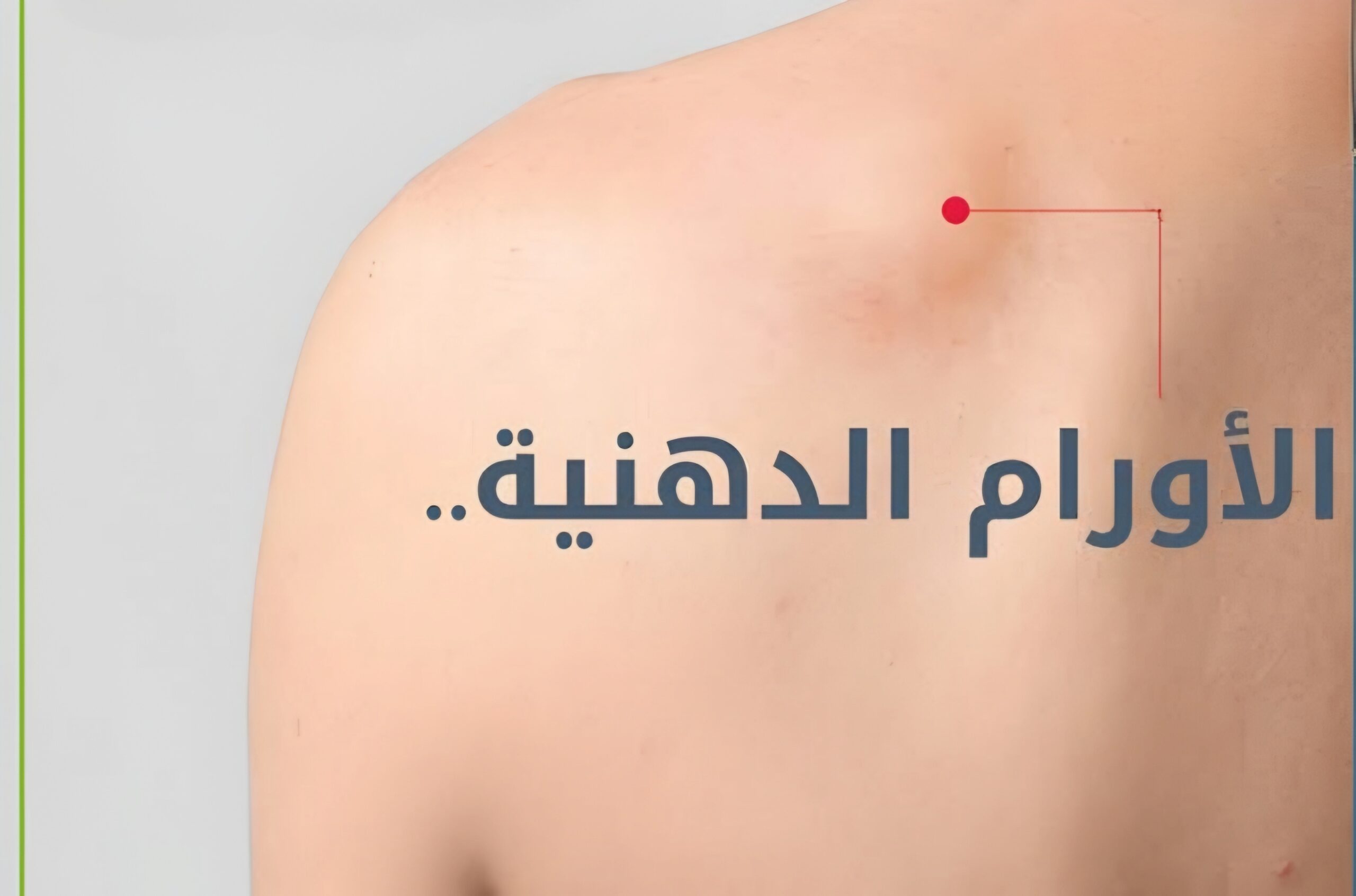 الفرق بين الخراج والورم الدهني