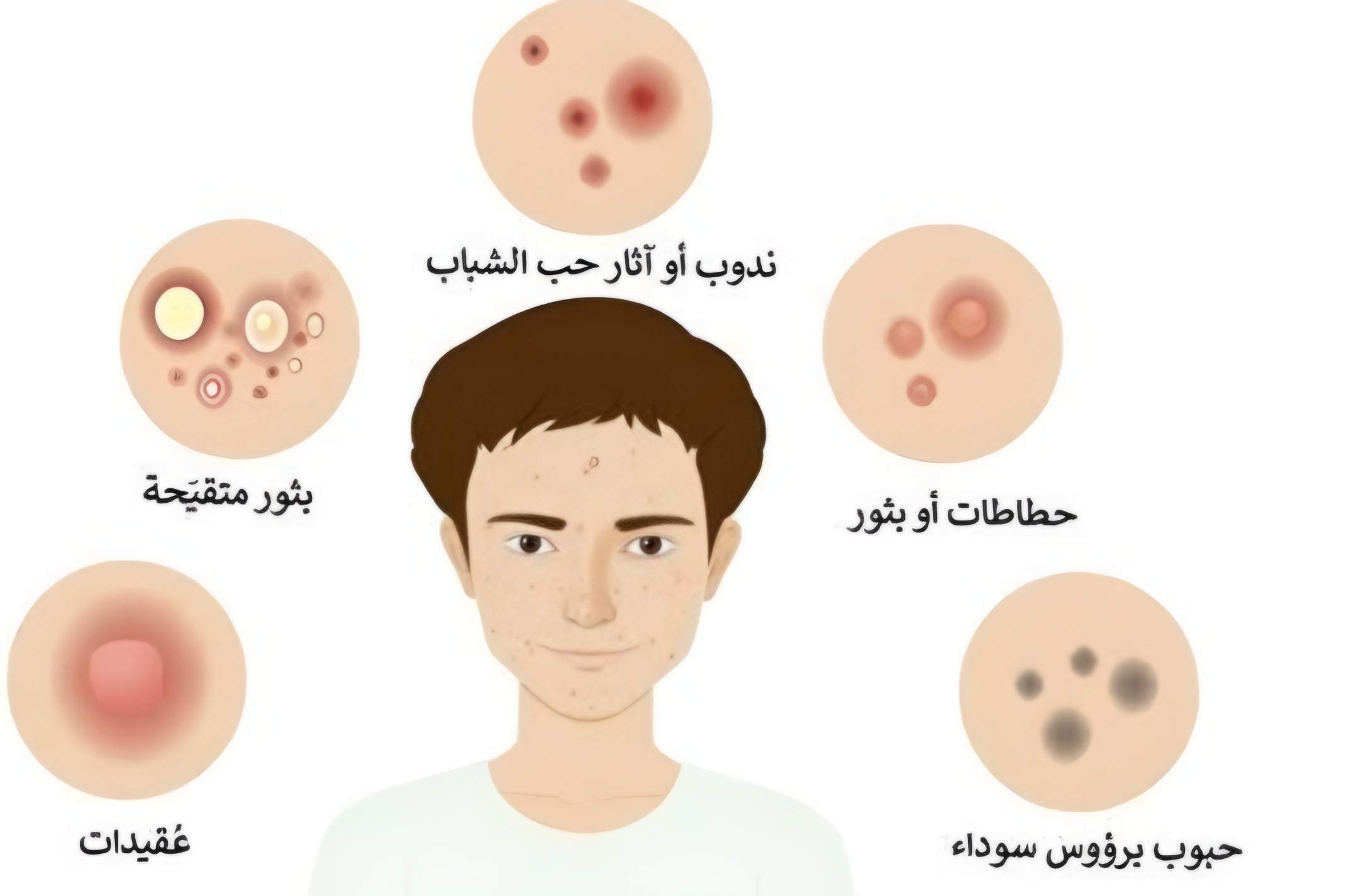 أنواع حب الشباب 